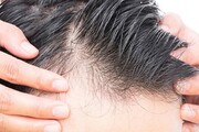 راه حل‌های ساده برای درمان ریزش موی شقیقه‌ها