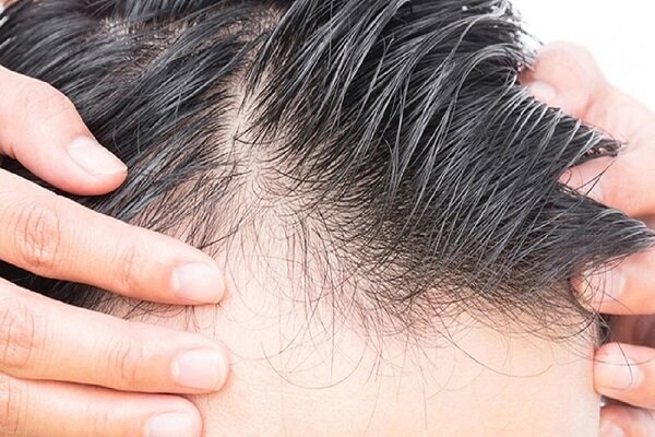 چه چیزی باعث ریزش مو در  مردان می‌شود؟ 