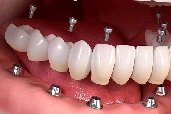 انواع ایمپلنت دندان را بشناسید