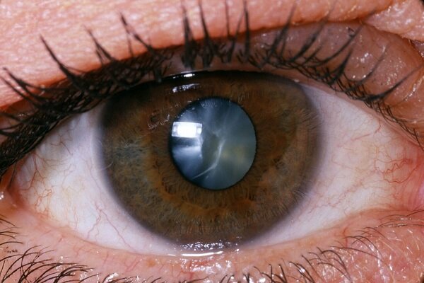 دو چشمی نشان از چه بیماری دارد؟