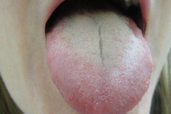 سفید شدن زبان زنگ خطری برای این بیماری‌هاست!
