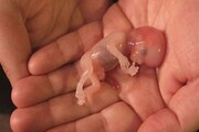 معرفی یک روش درمانی برای پیشگیری از سقط مکرر جنین