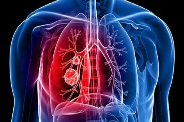 کشف تاثیر یک داروی جدید بر روی سرطان ریه