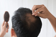 ریزش موی غیر قابل درمان با رژیم غذایی اشتباه