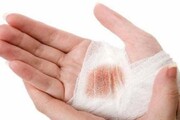 طب سنتی/ درمان زخم پوستی و سطحی در منزل