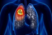 مهمترین نشانه سرطان ریه چیست؟