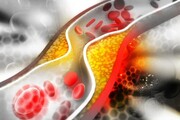 چربی خون منجر به پیشرفت سرطان می‌شود؟
