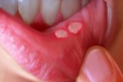 آفت‌هایی که نشان از سرطان دهان دارد؟
