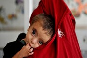 یونیسف: نیمی از کودکان زیر ۵ سال افغان سو تغذیه شدید دارند