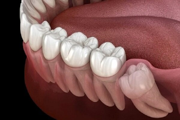 علائم پخش شدن عفونت دندان در بدن

