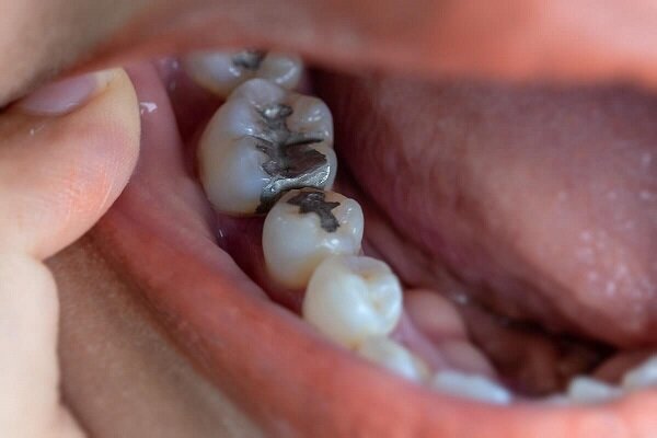 بیماری‌های دهانی که از عوارض عفونت هستند