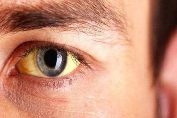 علل اصلی زردی چشم‌ها در سنین مختلف چیست؟
