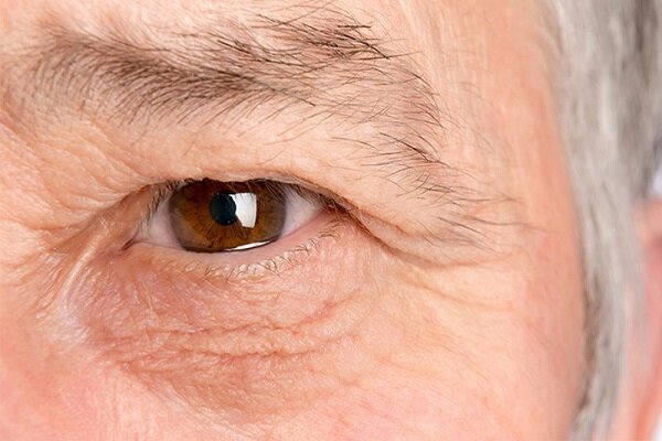 علت افتادگی پلک چشم چیست؟