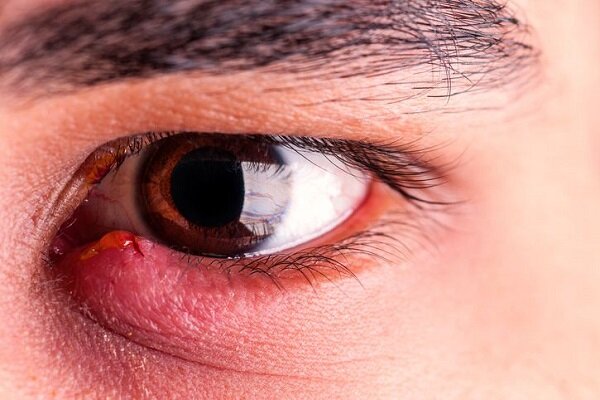 دلایل اصلی و مهم ایجاد گل مژه چیست؟