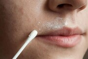 علل و درمان خشکی پوست اطراف دهان و لب