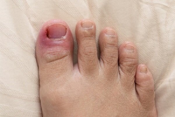 سوزش کف پا چه عللی دارد و چطور درمان می شود؟