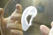 پیوند گوش چاپ شده از سلول‌های خود بیمار