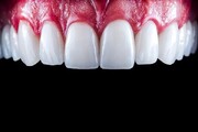 کدام زیباتر است؟ لمینت دندان یا کامپوزیت؟
