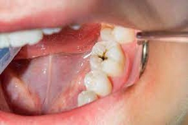 عوارض خطرناک دندان پوسیده برای سلامتی بدن