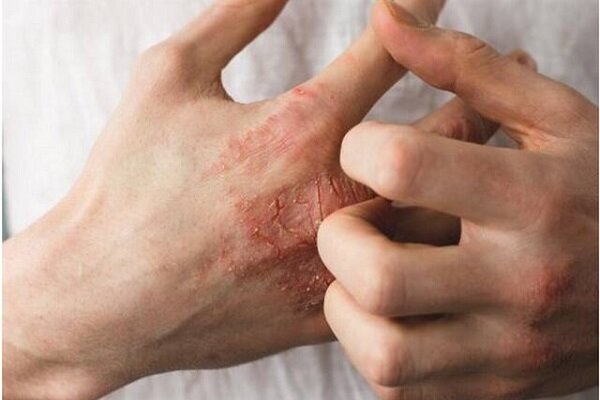 تاثیر مواد شوینده بر اگزمای دست/ چگونه این حساسیت پوستی درمان می‌شود؟
