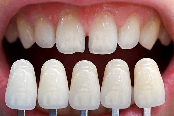 لمینت یا کامپوزیت دندان؛ کدامیک بهتر است؟