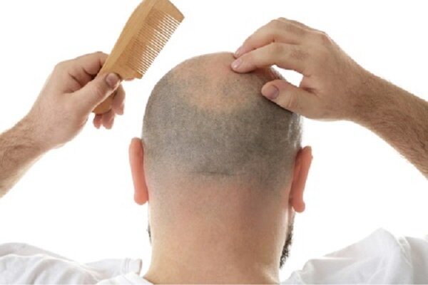 ریزش موی ارثی چیست و چگونه قابل درمان است؟