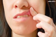 شیوه درمان آفت دهان با داروهای گیاهی