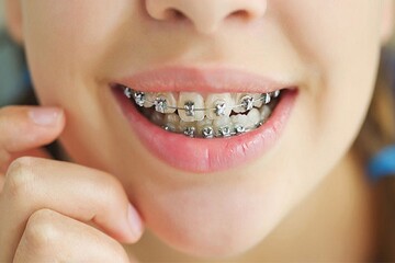  کشیدن دندان برای ارتودنسی الزامی است؟
