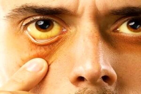 بروز لکه زرد در چشمان نشانه چیست؟