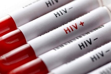 چگونه با HIV خوب زندگی کنیم؟