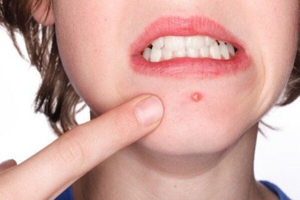 کدام مواد غذایی باعث جوش زدن روی صورت می‌شوند؟