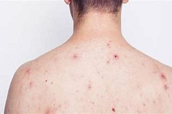 جوش‌های پشت کمر و شانه‌ها نشانه چیست؟