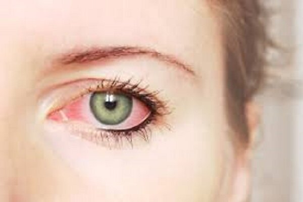 ۵ راه‌کار طبیعی برای درمان ورم ملتحمه چشم