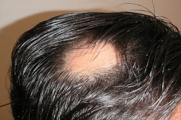 دلیل اصلی ریزش سکه‌ای مو چیست؟