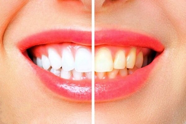 چگونه در خانه دندان‌های زردمان را سفید کنیم؟