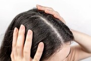 علت اصلی شوره زدن موها چیست؟