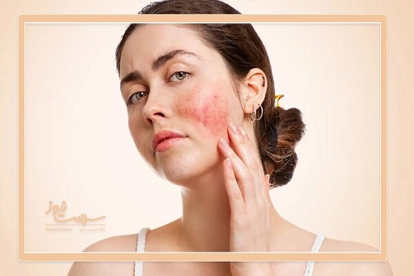 شناخت علائم بیماری لوپوس