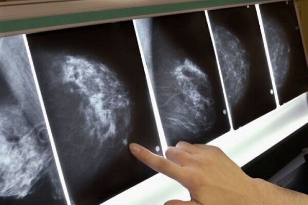 یکی از خطرناک‌ترین فاکتورهای سرطان سینه شناسایی شد