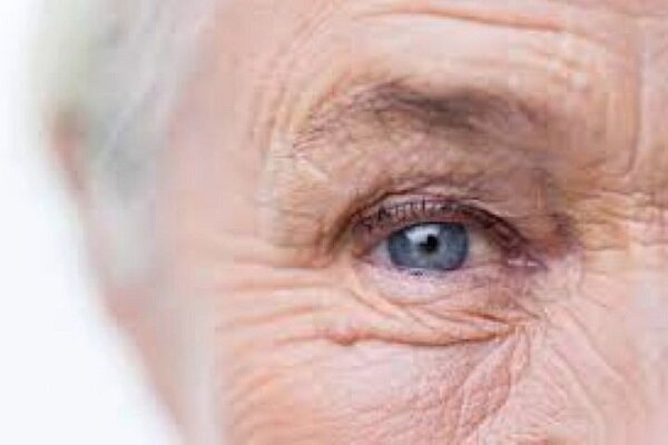 بیماری شایع چشمی در میان سالمندان