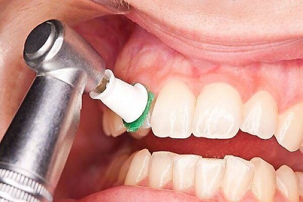 تعداد دفعات مجاز جرم‌گیری دندان در سال
