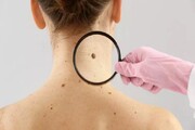 اولین نشانه‌های ابتلا به سرطان پوست چیست؟