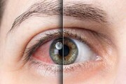 راه‌های جلوگیری از خشکی چشم