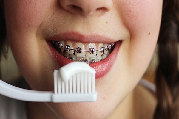 روش صحیح مسواک زدن ارتودنسی دندان