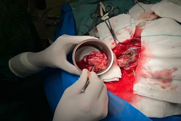 اولین عمل جراحی باز مغز در بیمارستان شاه ولی یزد انجام شد