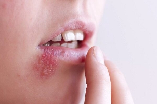 چگونگی تشخیص تبخال و جوش / راهکارهای موثر برای درمان چیست؟