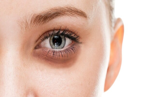 هرآنچه لازم است در مورد بیماری شبکیه چشم بدانید