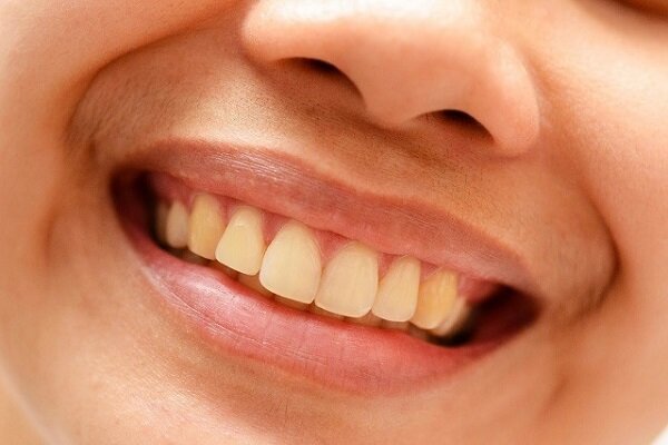 چرا دندان‌هایمان زرد می‌شوند؟