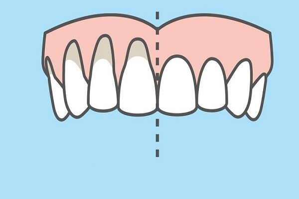 چرا لثه دچار عقب رفتگی می‌شود؟