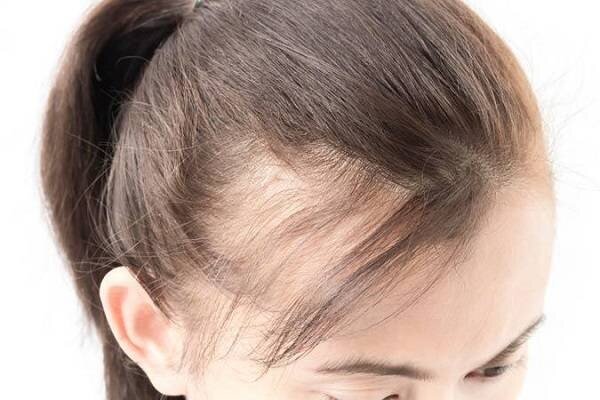 درمان‌های طبیعی برای ریزش مو