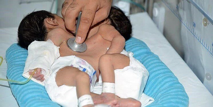 جدایی دوقلوی بههم چسبیده در شیراز + عکس